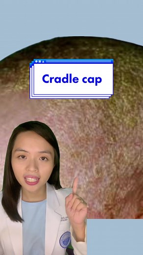 Understanding Cradle Cap: How to Treat Newborn Dandruff