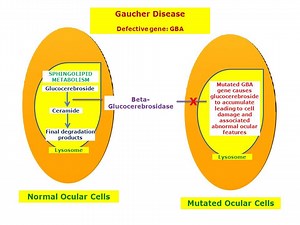 ゴーシェ病：原因、症状、および治療 - 子供の健康 2025