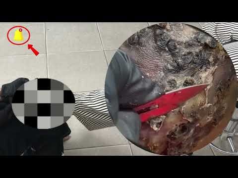 🤯 Jigger Infestation Horror – Skin Full of Parasites #DO164