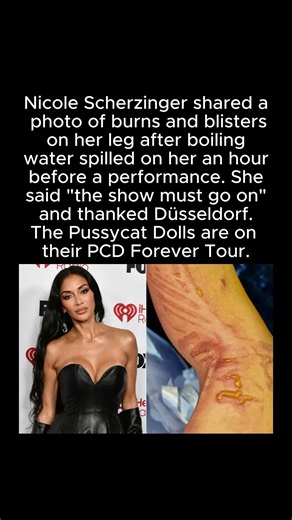 Nicole Scherzinger Suffers Leg Burns Before Pussycat Dolls Show #NicoleScherzinger #PussycatDolls