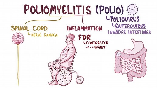 Video: Poliovirus - Video Explanation! | Osmosis | Osmosis