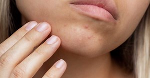 Bouton sur le menton : comment m'en débarrasser ?