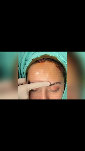 Forehead_reduction TikTok'ta