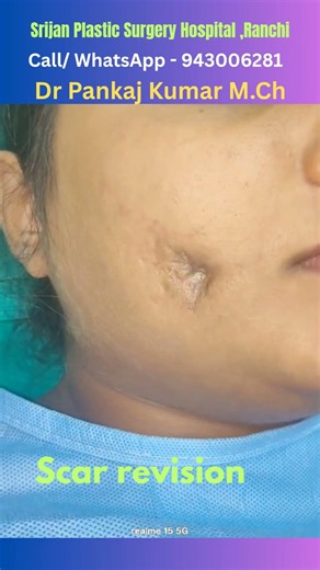 Scar revision surgery for check scar| scar revision surgery in Ranchi| Best scar treatment in Ranchi