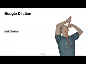 HCC 1475-38c-Bougie Dilator Self Dilation