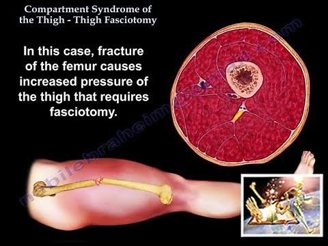 Compartment Syndrome Thigh Fasciotomy - Everything You Need To Know - Dr. Nabil Ebraheim