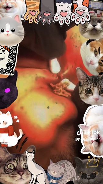 pop #ASMR #pimples #blackhead #pop #cyst#PIMPLE