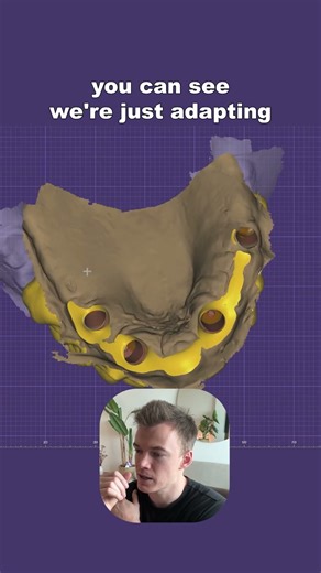 Final Tissue Adaption - exocad