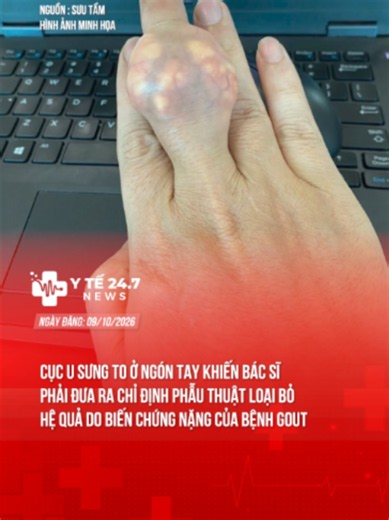 CỤC U SƯNG TO Ở NGÓN TAY KHIẾN BÁC SĨ PHẢI ĐƯA RA CHỈ ĐỊNH PHẪU THUẬT LOẠI BỎ - HỆ QUẢ DO BIẾN CHỨNG NẶNG CỦA BỆNH GOUT #theanh28 #yte247news #tiktoknews