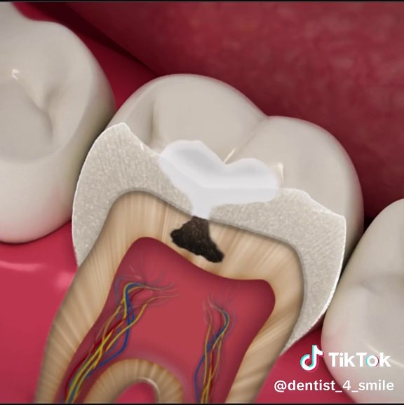 Effective Dental Cavity Removal Techniques Revealed