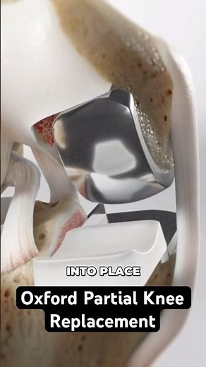Oxford Partial Knee Replacement (3D Animation)