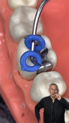 🔥Dental Separator Installer Pliers🔥 / 🔴 #CarnivalWithRedShorts