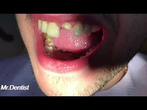 Dental Crown On Front Teeth - ALL CERAMIC CROWN !!