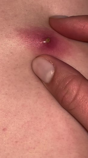 Tonsil stones on TikTok