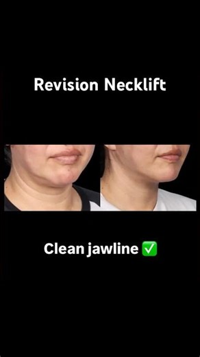 Revision Necklift After Liposuction | Fixing Neck Contour Deformities