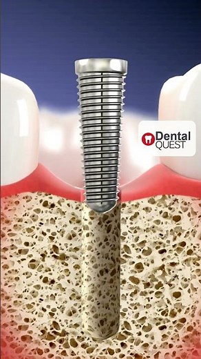 How Tooth Extraction Really Happens | 3D Dental Animation | Dentist in Dwarka | Dental Quest