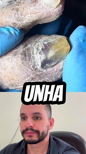 Onicomicose: Sintomas, Causas e Tratamento das Unhas Infectadas