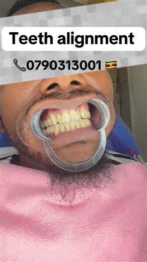 Improve Your Smile with Teeth Alignment Options