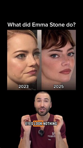 Emma Stone’s eyes look nothing like they did a few years ago, and it’s not just makeup 👀✨ Her brows appear slightly lifted, there’s more space between the brow and lashes, and her overall gaze feels more open. Could it be upper blepharoplasty or a surgical brow lift? Maybe. But today, non-surgical options like Botox, threads, and subtle fillers can create a similar result. Her glow could be the result of laser resurfacing or microneedling, and her cheeks show the kind of balance light filler ca