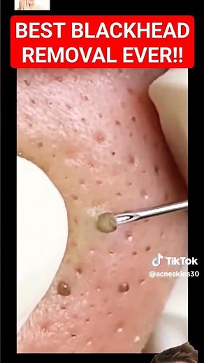 Best BLACKHEAD REMOVAL Ever! - So Satisfying #shorts