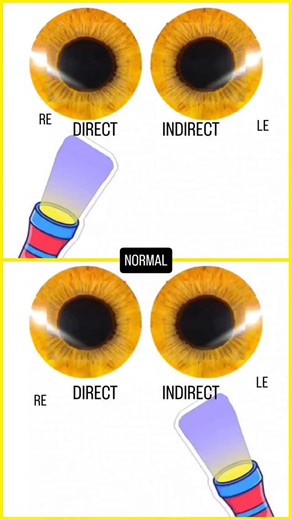 OphthaLove on Instagram: "RAPD GRADING (simplified) SFLT by Levitan RELATIVE AFFERENT PATHWAY DEFECT [(Feedback and corrections are welcome)]"