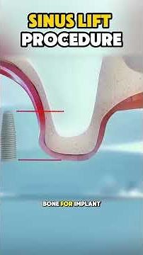 Sinus Lift Surgery Explained | Bone Augmentation for Dental Implants #sinuslift #dentalimplant