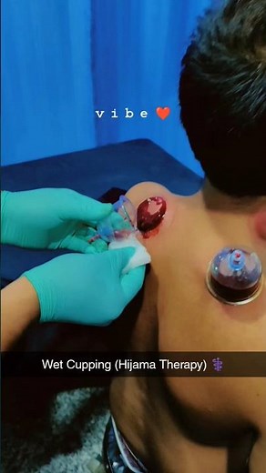 🩺 Wet Cupping / Hijama Therapy | By Dr. Shoeb (Physiotherapist) 🩹