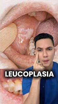 Check your oral cavity; this is how cancer (oral leukoplakia) can start. #dermatology #dermatologist