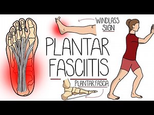 Plantar Fasciitis Explained Clearly (Including Treatment Options!)