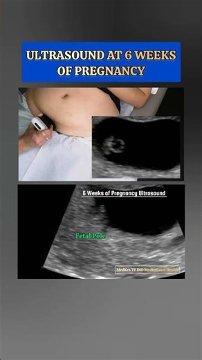 Early Pregnancy Ultrasound at 6 Weeks