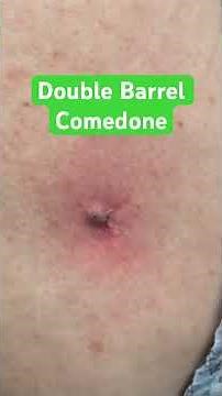 Blackhead with multiple openings!
