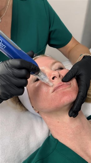 ✨ Glow like Dr Sam - Episode 1: SkinPen ✨ We’re kicking off a little mini-series where Dr Sam shares exactly what she does to keep her skin so glowy, smooth and tight. First up - SkinPen. A medical microneedling treatment that stimulates collagen and elastin, improving texture, tone and firmness over time. It’s one of Sam’s go-to treatments for maintaining that natural, healthy glow (and yes… she even does it on herself!). Keep an eye out for the next episode 👀 | Oxford Natural Clinic