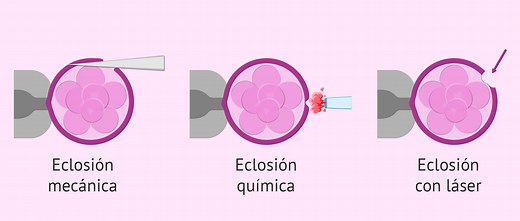 El hatching asistido antes de la transferencia embrionaria