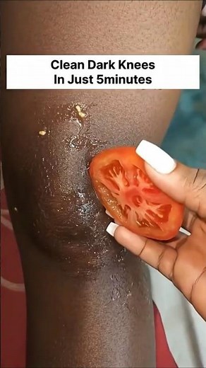 Black Knees Removal With Easy Home Remedy | Dark Knees & Elbows Whitening At Home #skincare #shorts