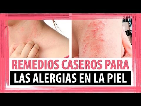 3 REMEDIOS CASEROS PARA LAS ALERGIAS EN LA PIEL COMO CURAR ALERGIAS EN LA PIEL