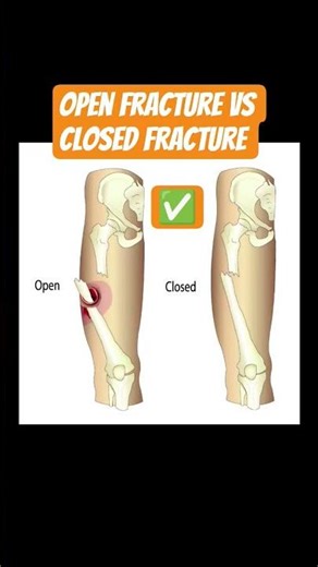 🔥Closed fracture|open fracture|bone fracture|fracture image|close fracture bone