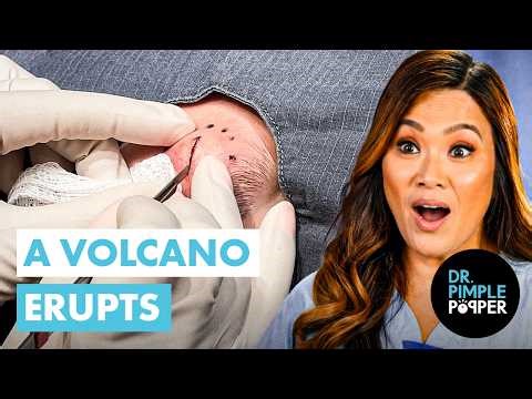 A Volcano ERUPTS in Front of Dr Pimple Popper! Facial Epidermoid Cyst Procedure