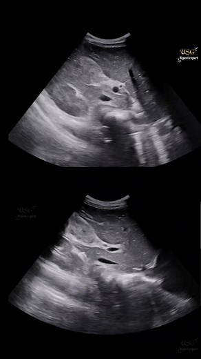 52K views · 456 reactions | How many disease in this clip #ultrasoundscan #radiology #medical #sonologist #doctor #ultrasoundstudio #ultrasoundtech #ultrasound #gallbladder #gallbladderhealth | Ultrasound report expert | Facebook