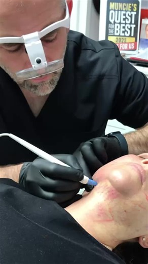 Agnes RF is revolutionizing the way we treat lower face concerns—permanently. By using precision microneedles and targeted radiofrequency energy, Agnes safely melts fat while tightening and firming the skin. 🔬 Treats: – Double chin – Jowls – Jawline laxity – Undereye bags – Acne & More This isn’t just a treatment. It’s a transformation. 💫 You deserve to feel amazing in your skin. Let’s talk about what Agnes RF can do for you. Schedule your consult today! 📍 Muncie, IN ☎️ 765 -372-8187 . . . #M