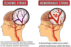 CVA stroke, causes, symptoms, diagnosis, treatment, recovery & prognosis