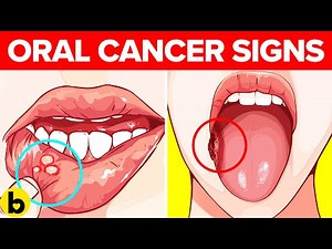 Warning Signs of Oral Cancer: Symptoms, Risk Factors And Treatment Options