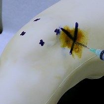 Video: Knee Arthrocentesis in Adults