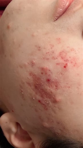 Sarah S. on Instagram: "Before any acne facial: assessment, gentle prep, controlled extractions, and calming care — no shortcuts. #skincareroutine #acneawarenessmonth#teenacnetreatment#ancesolutions #professıonalskincare #educationandtraining #clearskingoals #consistencyiskey #donťgiveup #customised#treatment #plans#getresults #cosmotology"