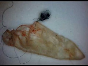How I Got Morgellons Disease? Morgellons Is Aspergillus Fumigatus Invasive Fungi & Highly Contagious