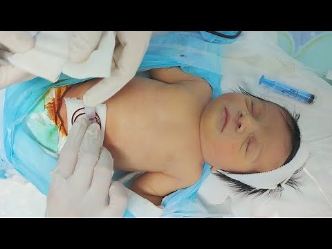 👶UVC Insertion + Suturing in Neonate: Clinical Procedure