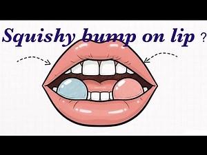 Squishy Lip Bump? It Might Be a Mucocele (Mucous Cyst) | Causes, Symptoms & Treatment #Mucocele #Lip