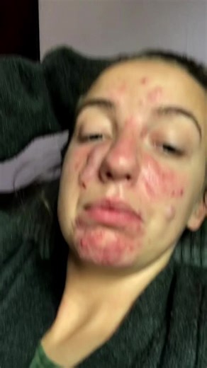 #acnefighter#roacutancheck 🙌❤️