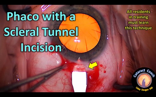 Cataract Surgery using a Scleral Tunnel Incision