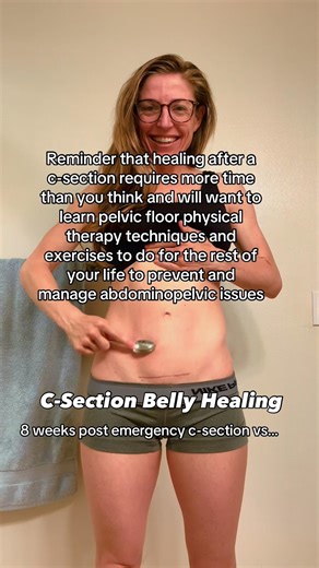 C-Section Healing 8 Weeks vs 3 Years Postpartum! TRY THIS! #mom #pregnancy #women #csection #fitness
