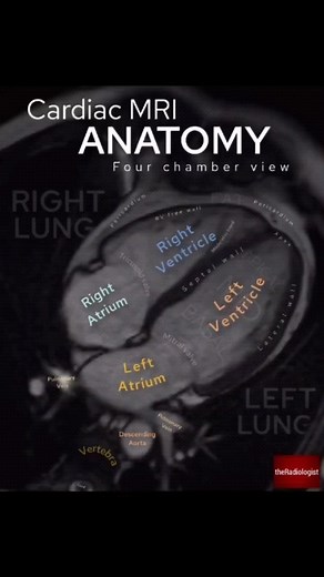 Imaging a beating heart...⁣ ⁣ ⁣Repost from @theradiologistpage🔻 ⁣ CARDIAC MRI FOUR CHAMBER VIEW⁣ 👨🏽‍💻Here we have a ‘4 chamber view’ of a cardiac MRI - this ‘cine’ image gives us a view of the right and left atria and both ventricles, hence the term ‘four chamber’⁣ ⁣ 👨🏽‍💻We can identify the left ventricle by its thick wall - on this image we can assess the septal and lateral walls as well as the apex. We can look to see if there is any poor movement of the LV wall which may be induced by